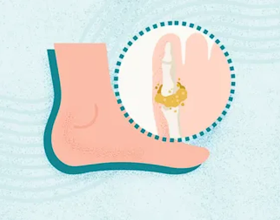 Gout treatment medicines for uric acid control and joint pain relief