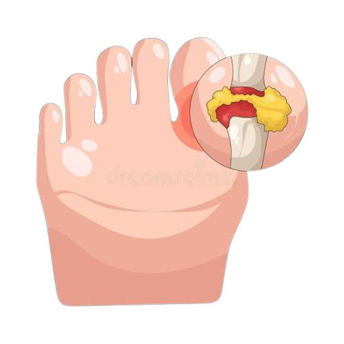 gout care removebg preview